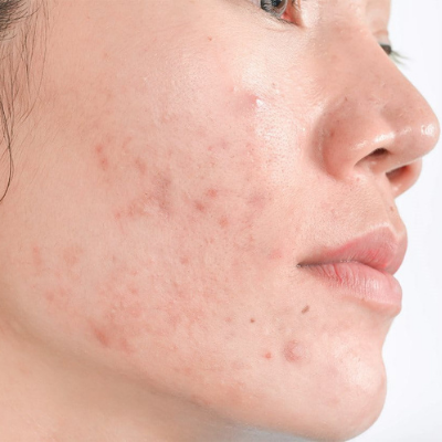 Skin Depigmentation